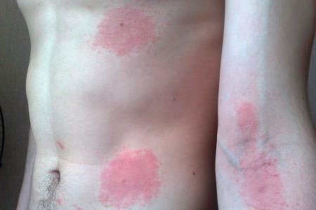 Симптомы аллергии на укусы блох у человека — лечение аллергии на укус блохи