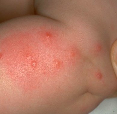 Как выглядит укус блохи на теле человека: симптомы и фото