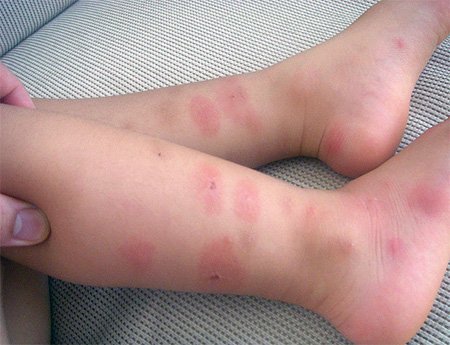 Аллергия на клопов симптомы и лечение — аллергия на клопов у детей